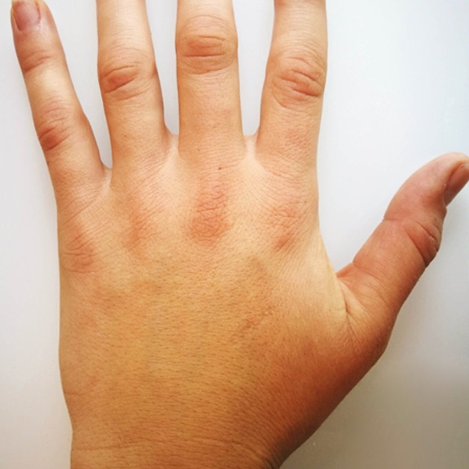 BioRePeelCl3 BODY treatment course — after