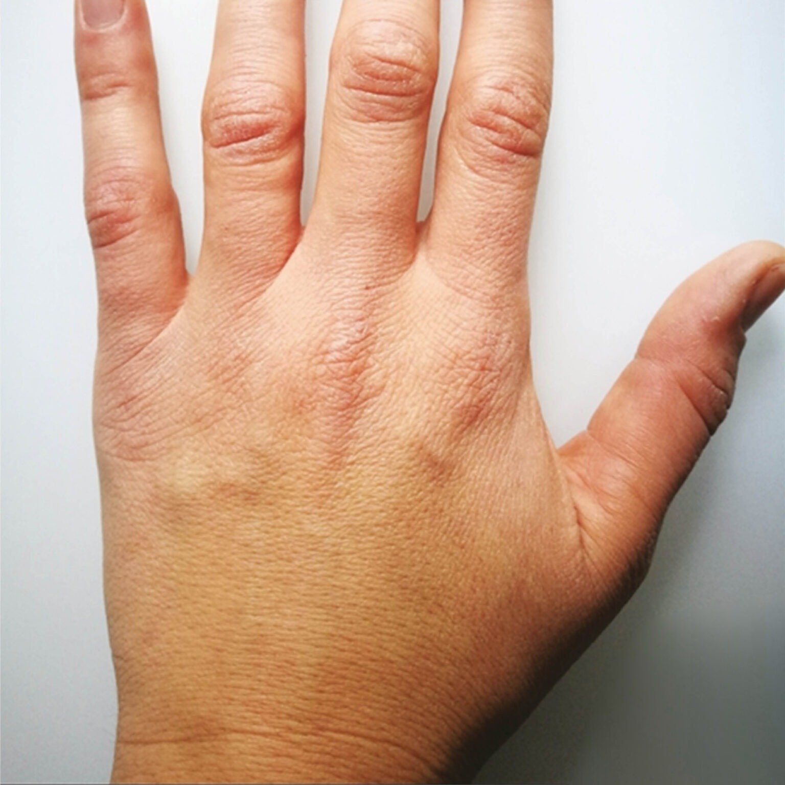 BioRePeelCl3 BODY treatment course — before