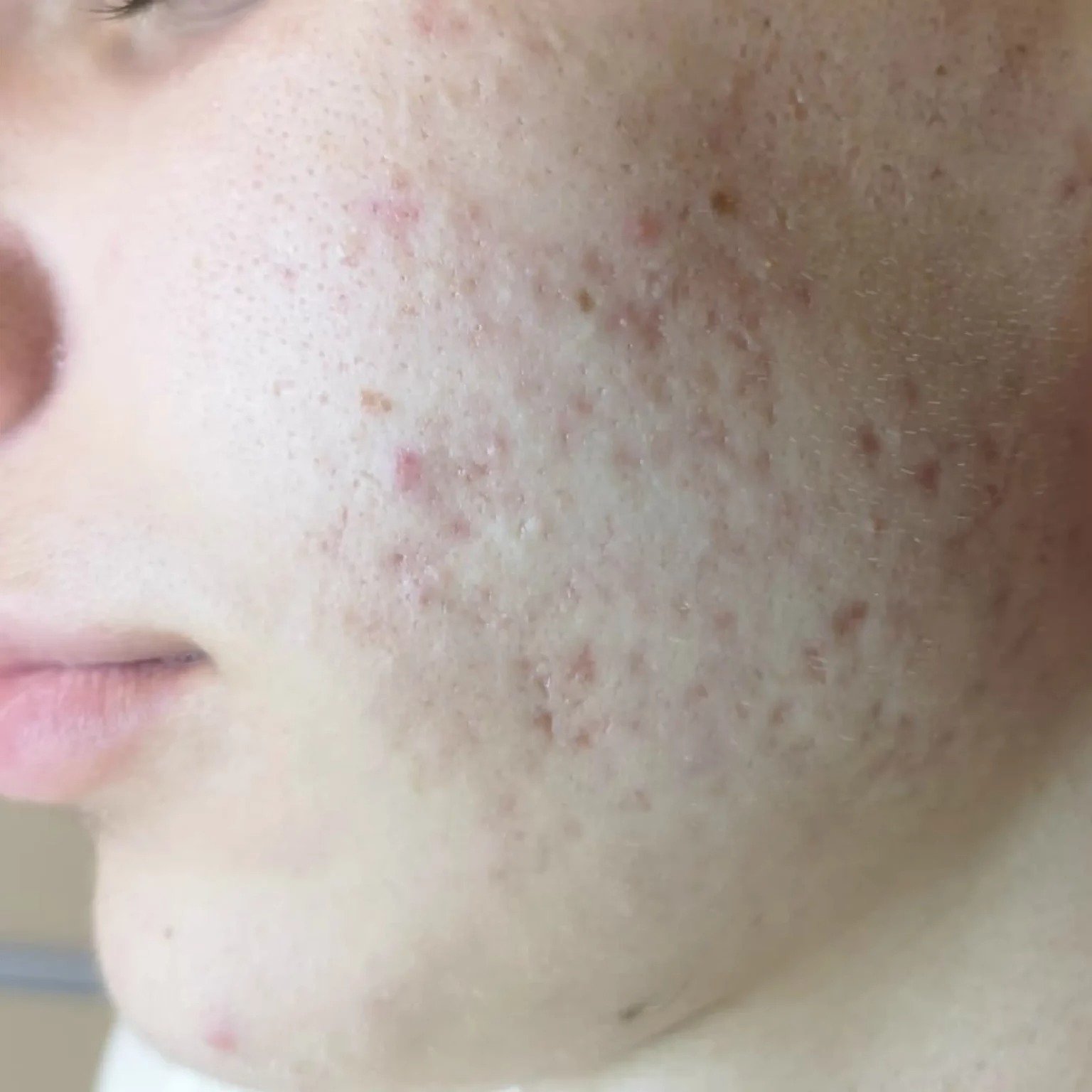 BioRePeelCl3 FND treatment course — after