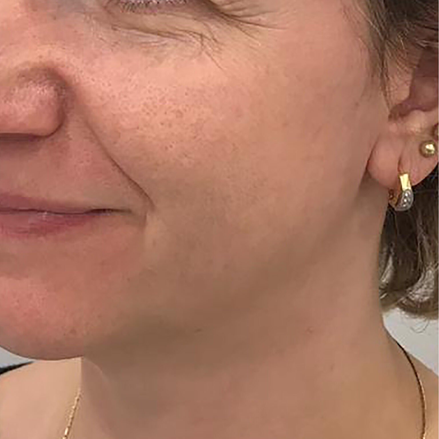 BioRePeelCl3 FND treatment course — after