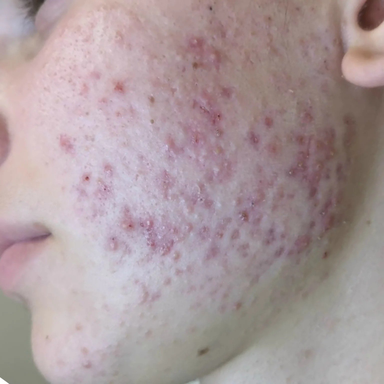 BioRePeelCl3 FND treatment course — before