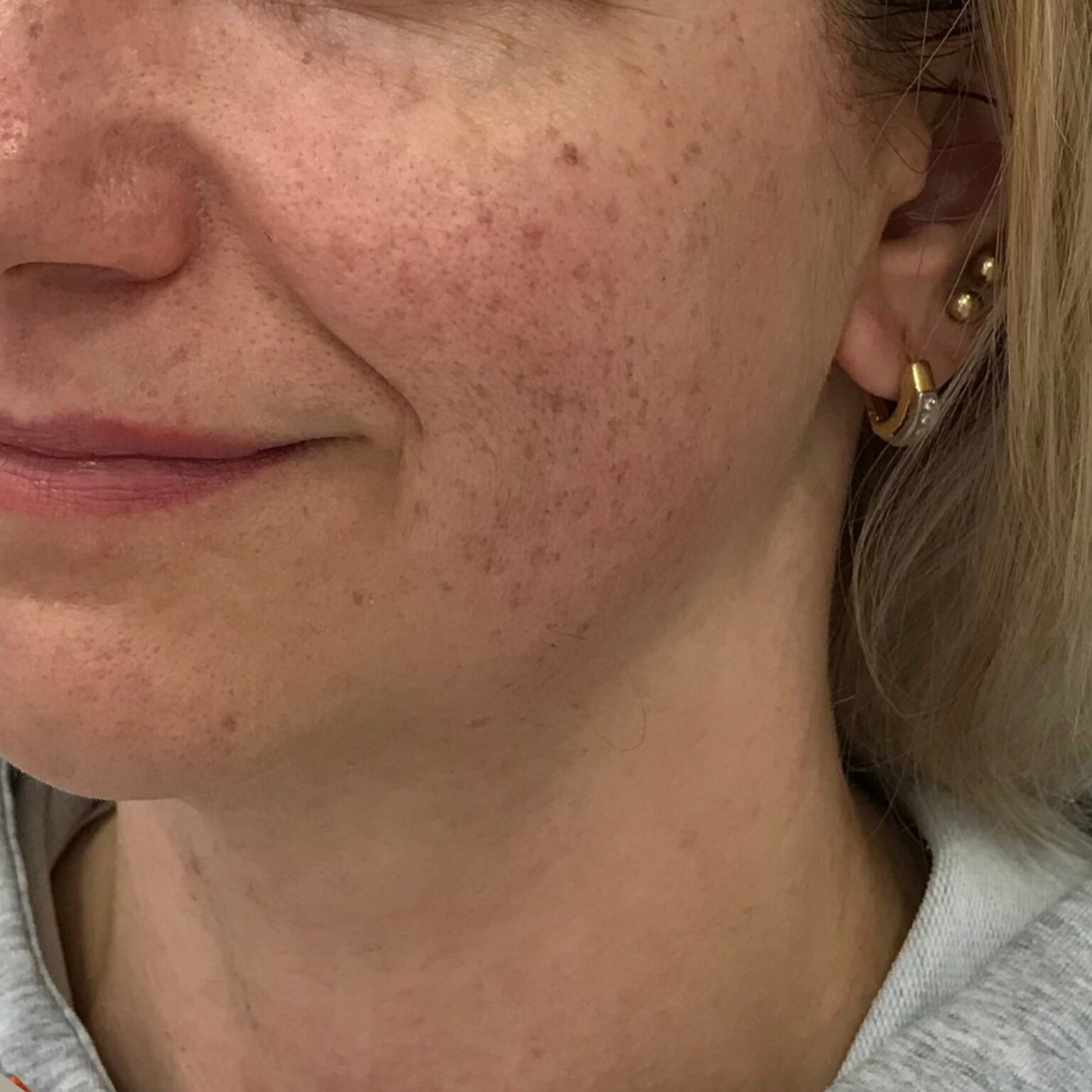 BioRePeelCl3 FND treatment course — before
